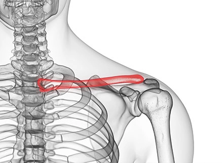 Clavicle Fracture
