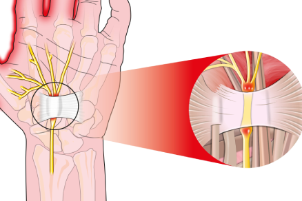 Ligament Reconstructions